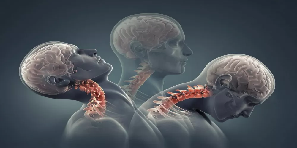 Contrary to expectations, aerobic exercise helps speed up recovery from concussion.sv